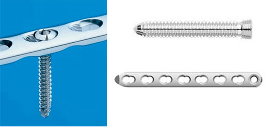 最新の骨折整復