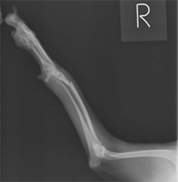 最新の骨折整復