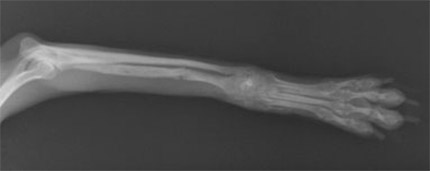 骨萎縮した症例に体する同種皮質骨移植手術