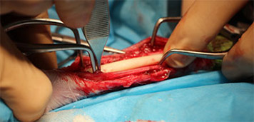 骨萎縮した症例に体する同種皮質骨移植手術