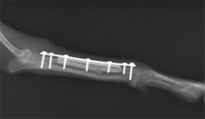 骨萎縮した症例に体する同種皮質骨移植手術