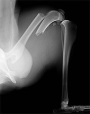 後足大腿骨骨折