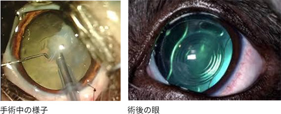 白内障手術のための術前検査