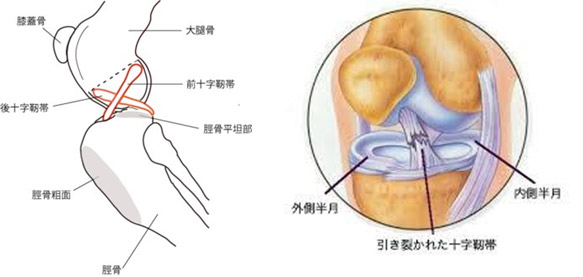 前十字靭帯断裂症