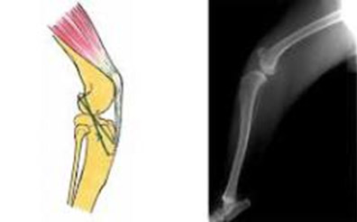 前十字靭帯断裂症