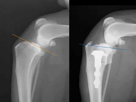 前十字靭帯断裂症