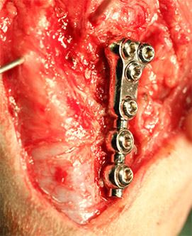 前十字靭帯断裂症