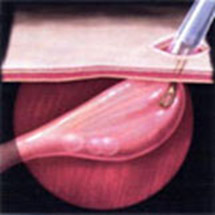 腹腔鏡下膀胱結石摘出手術