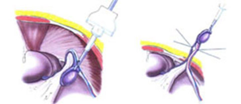 腹腔内停留睾丸（陰睾）の摘出手術