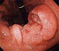 胃の悪性腫瘍