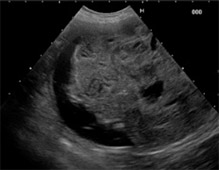 泌尿器系の悪性腫瘍