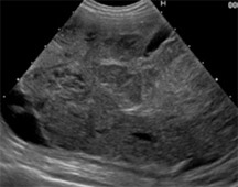 泌尿器系の悪性腫瘍