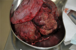 泌尿器系の悪性腫瘍