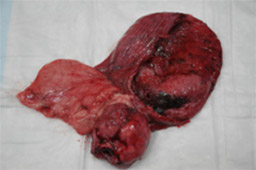 泌尿器系の悪性腫瘍