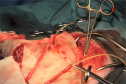 泌尿器系の悪性腫瘍