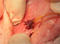 泌尿器系の悪性腫瘍