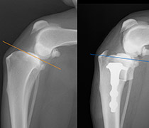 前十字靭帯断裂症