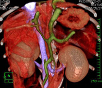 門脈体循環シャント