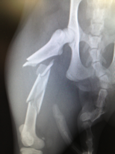 骨片が５つ以上あり、複雑骨折と診断